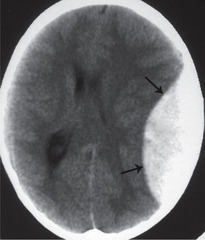 <p>Between inner surface of skull and dura mater.</p><p>Biconvex in shape, limited by cranial sutures.</p><p>Frequently arterial & associated with head trauma (eg. pterion trauma -> middle meningeal artery)</p>