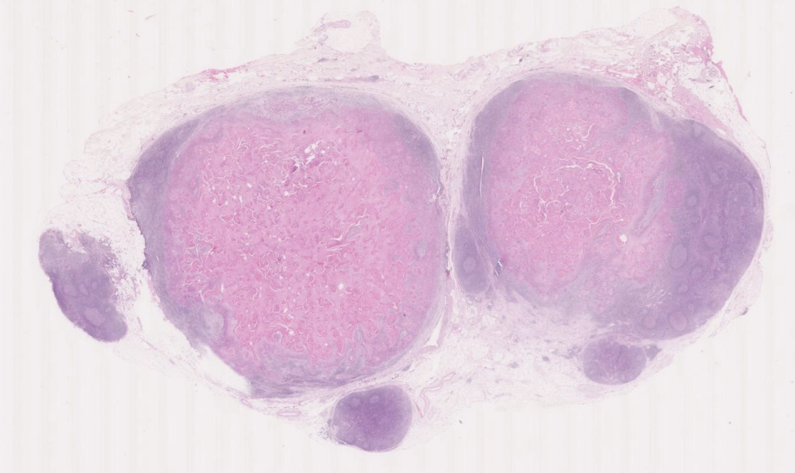 <p>The slide below (which you can view using the hyperlink) shows two enlarged lymph nodes from the neck of a 67 year old man </p>
