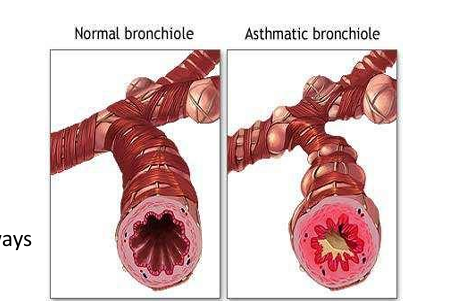 asthma causes airway inflammation and bronchoconstriction