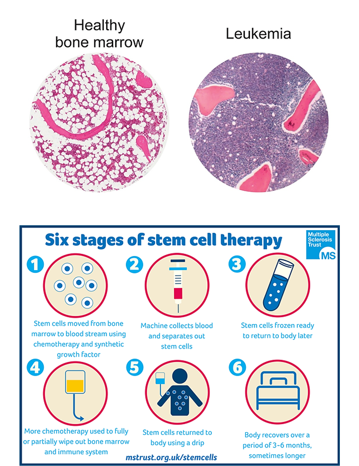 <ul><li><p>Stem cell transplants (therapy) are mainly used to treat blood disorders like leukaemia</p></li><li><p>Leukaemia is treated with chemotherapy and radiation to destroy diseased cells</p></li><li><p>These treatments also destroy healthy cells</p></li><li><p>Injected stem cells help replace and rebuild healthy blood cells afterwards</p></li></ul><p></p>