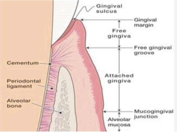 <ul><li><p>Is the shallow crevice or space around the tooth bounded by the surface of the tooth on one side and the epithelium lining the free margin of the gingiva on the other side.</p></li><li><p class="p1">t is V shaped, and it permits the entrance of a periodontal probe</p></li><li><p class="p1">The clinical determination of the depth of the gingival sulcus is an important diagnostic parameter.</p></li><li><p class="p1">The histologic depth of a sulcus will not be equal to the depth of penetration of the probe.</p></li><li><p class="p1">The so-called probing depth of a clinically normal gingival sulcus in humans is less than 3 mm</p></li></ul><p></p>