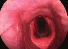<p>What is your diagnosis:</p><p>a. left laryngeal hemiplegia</p><p>b. right laryngeal hemiplegia</p><p>c. dorsal displacement of the soft palate</p><p>d. pharyngeal collapse</p>
