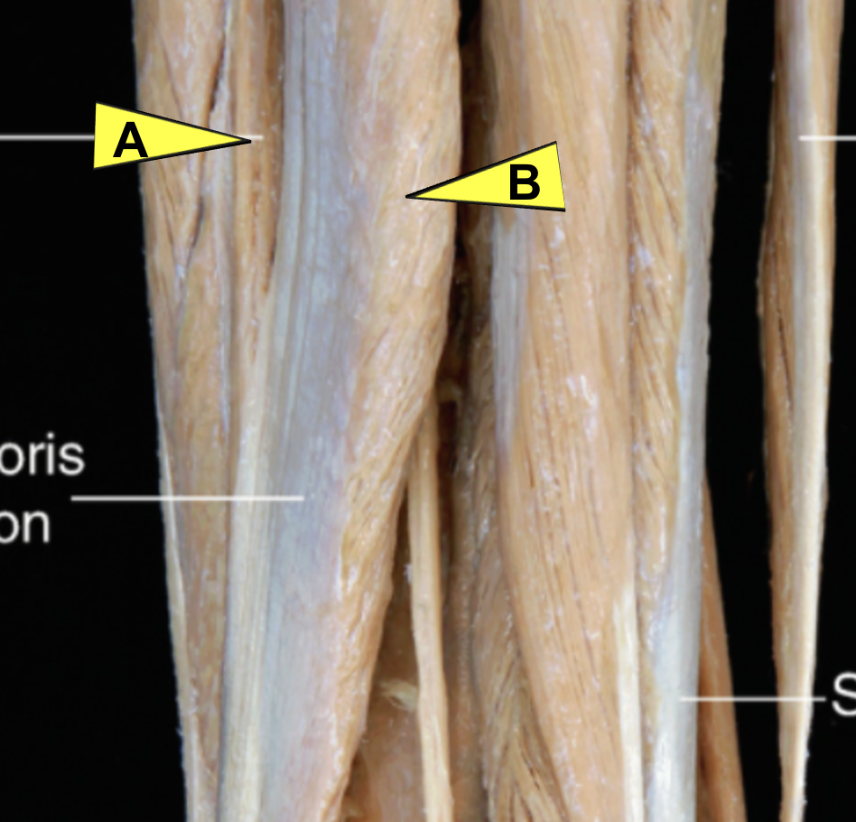 <p>ID muscles *hint this is above adductor hiatus and posterior /lateral to vastus lateralis</p>