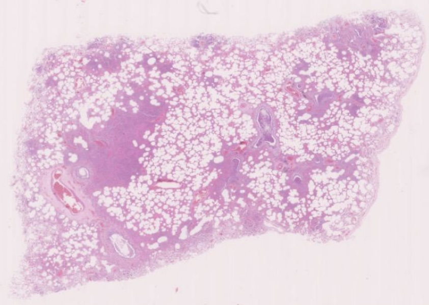 <p>lung from an 80 year old female, who had had a previous stroke, who was found dead at home.</p>