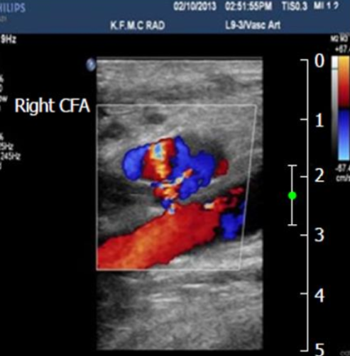 <ul><li><p><span style="background-color: transparent;">Pocket of swirling flow adjacent to an artery</span></p></li><li><p><span style="background-color: transparent;">Typically the result of an injury or tear to the vessel wall such as…</span></p><ul><li><p><span style="background-color: transparent;">Percutaneous arterial catheterization</span></p></li><li><p><span style="background-color: transparent;">Penetrating trauma</span></p></li><li><p><span style="background-color: transparent;">Bypass graft anastomosis blowout</span></p></li></ul></li><li><p><span style="background-color: transparent;">There are no walls encapsulating the structure</span></p></li><li><p><span style="background-color: transparent;">Treatment: thrombin injection and manual compression</span></p></li></ul><p></p>