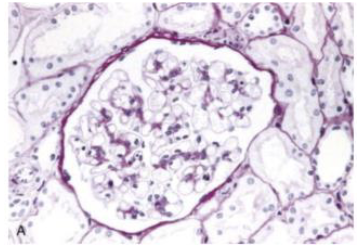 <p>What condition is seen here?</p>