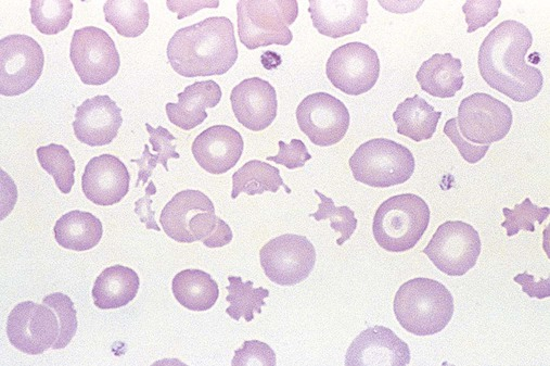 <p>what are some lab findings in a patient with traumatic cardiac hemolytic anemia</p>