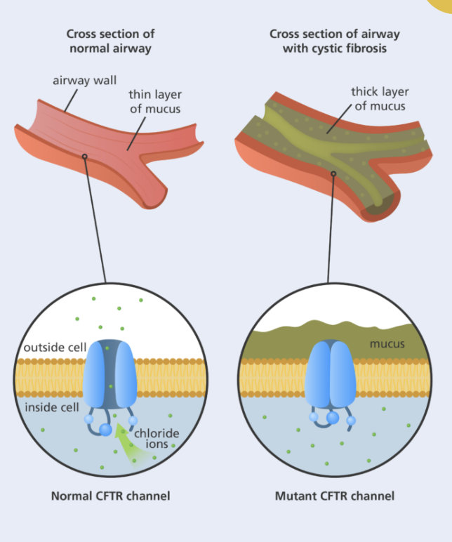 <p>Cystic Fibrosis can be caused by a deletion of a single base, causing a frameshift OR by</p><p>the deletion of the whole codon on chromosome number 7.</p><p>In people with Cystic Fibrosis (CF), mutations in the cystic fibrosis transmembrane</p><p>conductance regulator (CFTR) gene cause the CFTR protein to become dysfunctional.</p><p>When the CFTR protein to becomes dysfunctional, patients experience excess mucus in the lungs and digestive system.</p><p>Cystic fibrosis is a recessive trait, meaning both alleles must be passed on to the child for the disease to be present.</p>