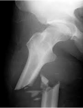 <p>One in which the bone is splintered or crushed</p>