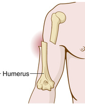 <p>- broken ends of bone protrude through the skin</p>