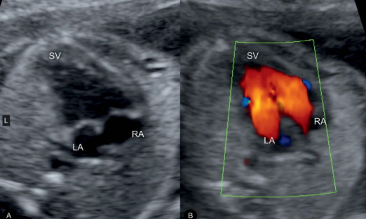 <ul><li><p><span style="background-color: transparent;">LA and RA feed into LV</span></p></li><li><p><span style="background-color: transparent;">US findings: single ventricle + 2 atria w/ valves on 4CH</span></p></li></ul><p></p>