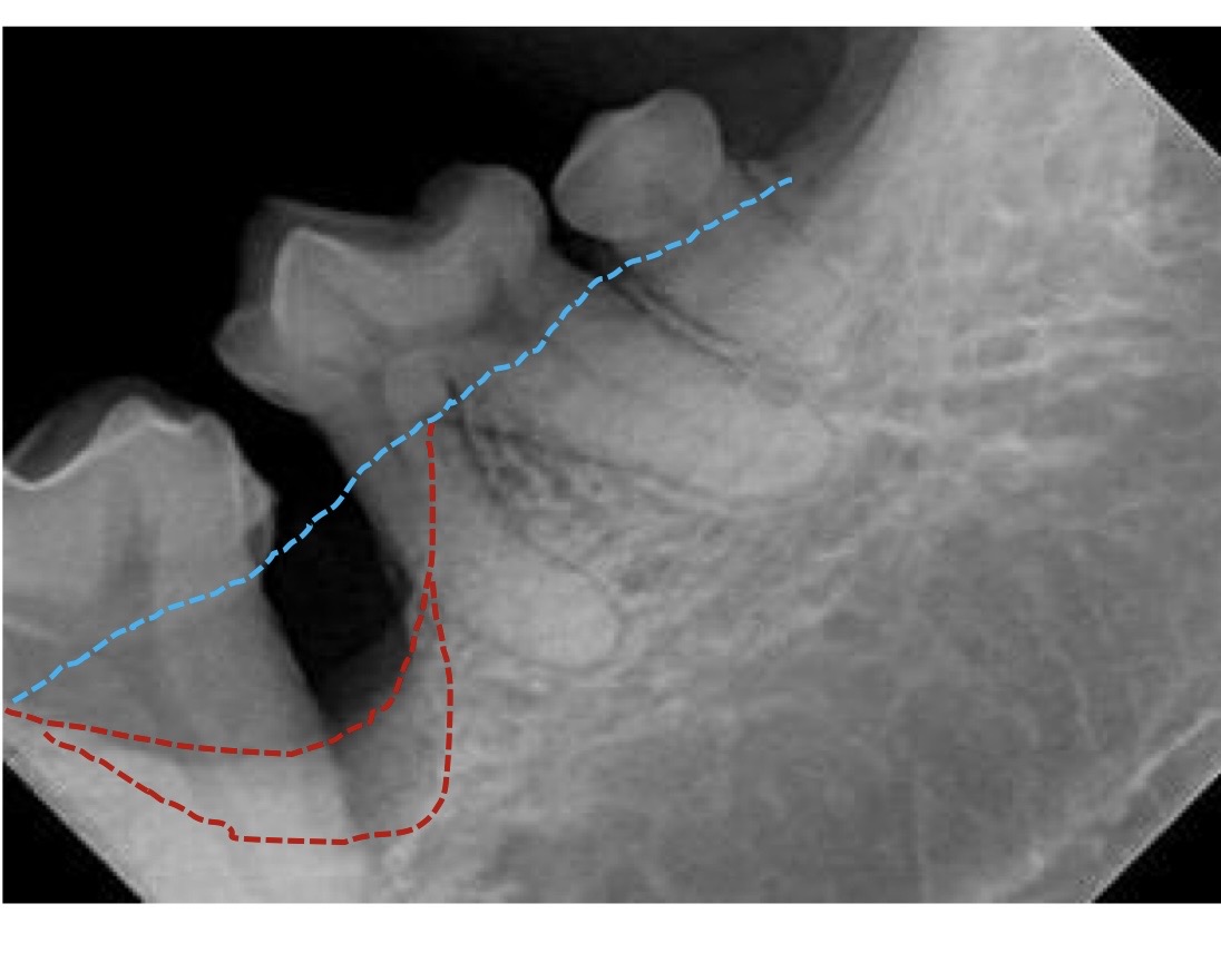 <p>what bone loss pattern is this?</p>