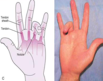 <p>Trigger Finger (tenovaginitis stenosans)</p>