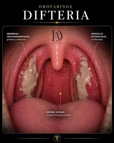 <p><strong>Pregunta / Caso:</strong> Escolar de 7 años presenta odinofagia moderada, febrícula y a la exploración orofaríngea se observa una pseudomembrana gruesa grisácea y adherente sobre las amígdalas que sangra profusamente al intentar desprenderla, acompañada de "cuello de toro". ¿Qué patología representa, cuáles son las precauciones de enfermería y cuál es su inmunógeno?</p>
