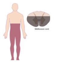 <p><span style="background-color: transparent;"><span>-Caused by flexion injuries</span></span></p><p><span style="background-color: transparent;"><span>-Bilateral loss of motor, pain, and temperature</span></span></p><p><span style="background-color: transparent;"><span>-SPARED: proprioception, discriminative touch</span></span></p><p><span style="background-color: transparent;"><span>MOST COMMON</span></span></p><p><br></p>