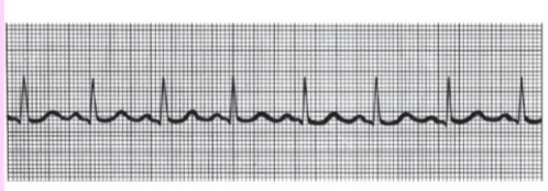 <p>P wave, QRS complex, and T wave present consistently</p>