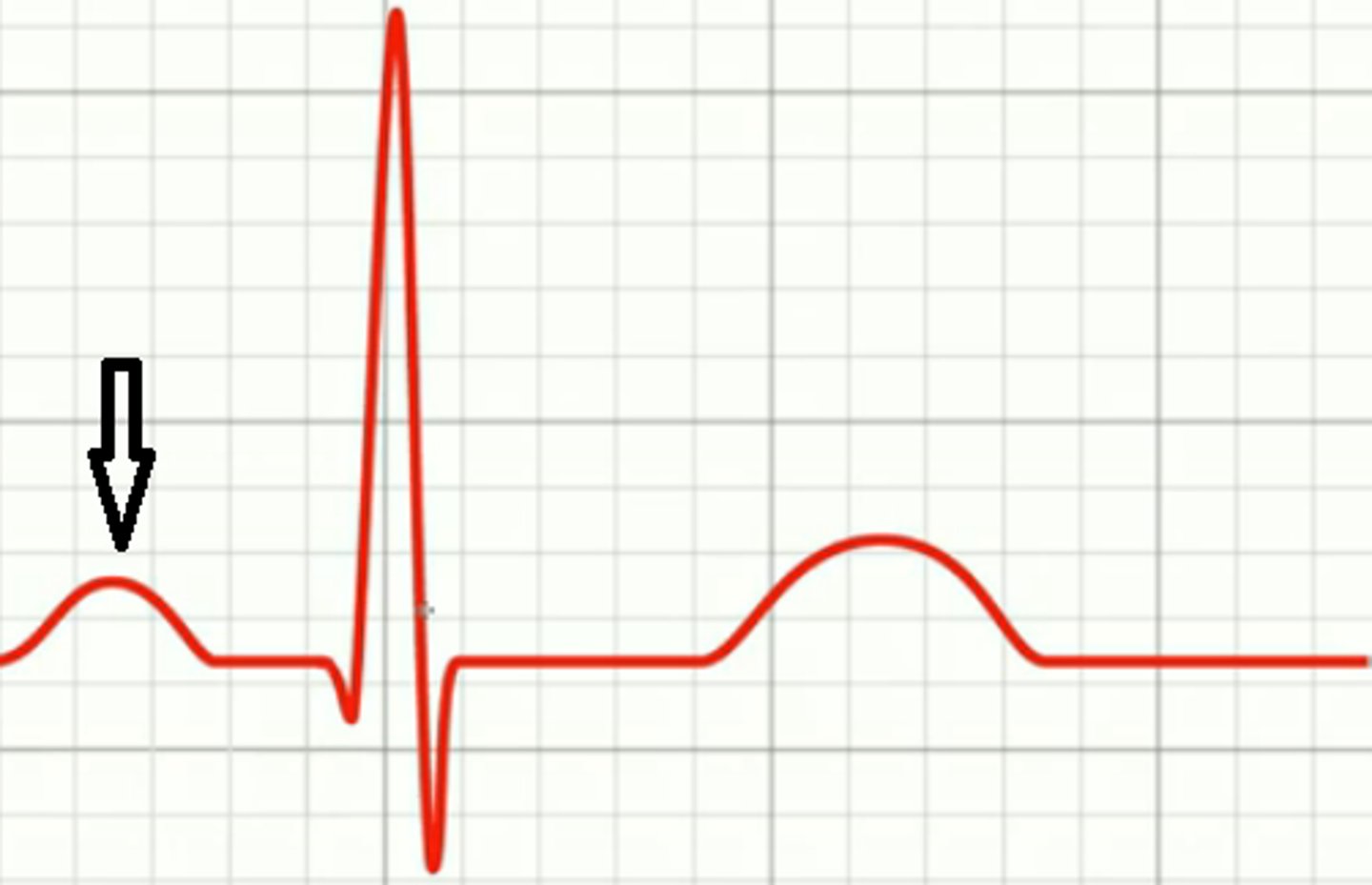 <p>atrial depolarization; time measured in seconds; height of the wave is measured in mV</p>