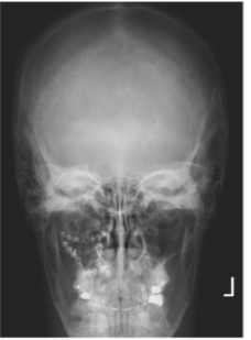<p>PA skull</p>