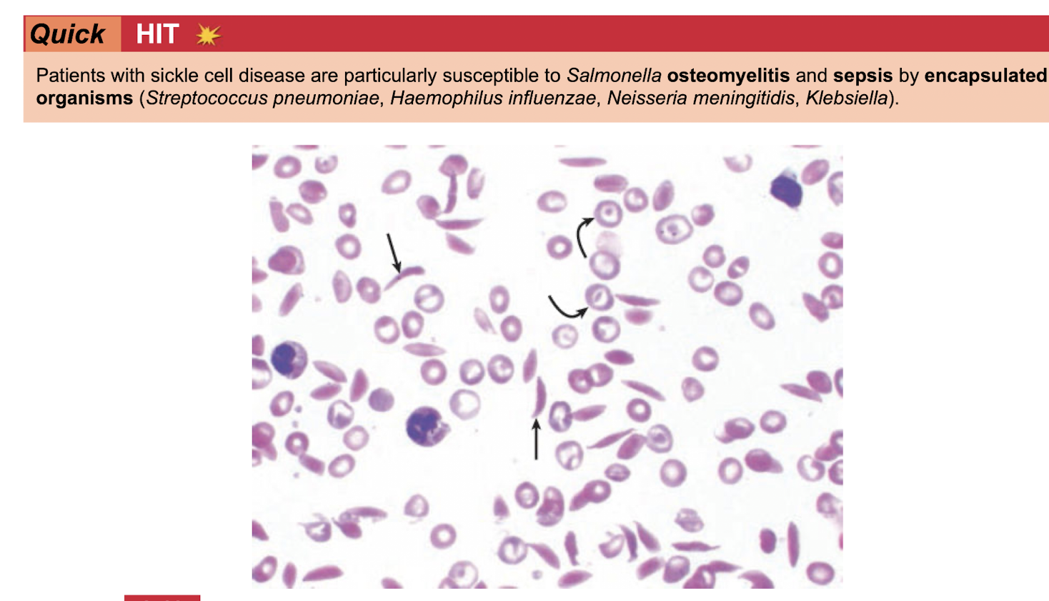 <p>Salmonella osteomyelitis&nbsp;</p><p class="p1">Sepsis by NSH + klebsiella (encasuplated)&nbsp;</p>