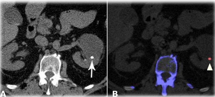 <p>62 let, Ž, poslabšanje stanja – huda bolečina ledveno, neodzivna na analgetično terapijo, vročina, dodatno zvišanje parametrov vnetja</p><p></p><ol><li><p>Imenuj tehniko slikanja </p></li><li><p>Kateri organ je prikazan? </p></li><li><p>Diagnoza? </p></li><li><p>Sestava spremembe?</p></li></ol><p></p>