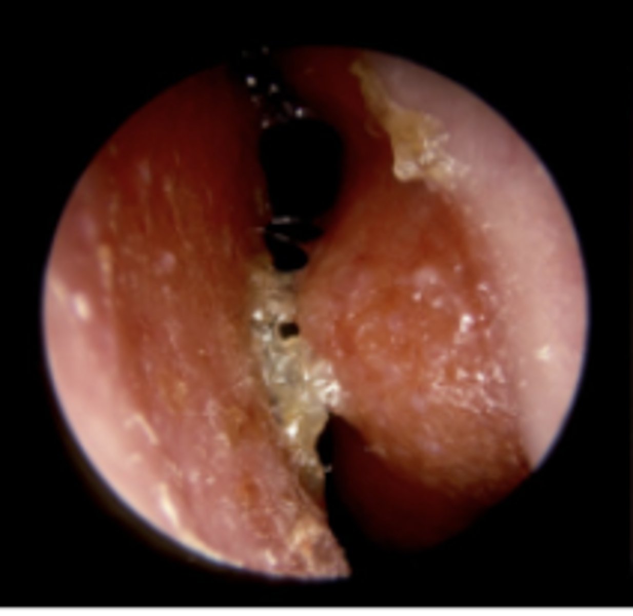 <p>nasal mucosa = red, smooth, moist, irritatedviral cold/infection</p>