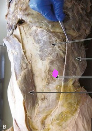 <p>Origin of the muscle with the pink dot </p>