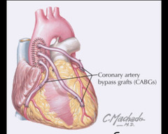 <p>What vessel is most commonly used for coronary triple bypass grafts?</p>