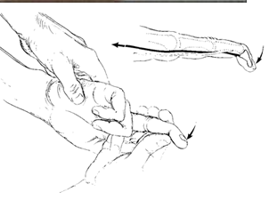 <ul><li><p>Jersey Finger - Flexor Digitorum Profundus (FDP) Rupture</p></li><li><p>MOI- usually occurs on the ring finger when an athlete grabs an opponent’s jersey</p></li><li><p>A disruption of the FDP tendon occurs because the DIP joint is actively flexed and then forced into extension.</p></li><li><p>Either ruptures or avulses tendon </p></li><li><p>The ring finger is involved in up to 75% of reported cases, but any digit may be injured. </p></li></ul><p></p>