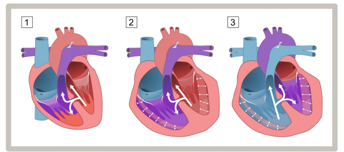 <p><strong><u>Mx</u></strong>: <em>nutrition, diuretics, ACEi, Surgical Closure</em></p><p><strong>First Line</strong>: Echocardiogram monitoring (small defects often heal spontaneously)</p><p><strong>Long Term:</strong> Surgery (VSD closure if sx)</p><ul><li><p><em>Indications</em>: children <1yr w pulmonary HTN, children not improved w medical therapy</p></li></ul><p></p><p><strong>Cx</strong>: pulmonary HTN, HF, cyanotic disease (TOF, truncus arteriosus), arrhythmias, Eisenmenger syndrome, infective endocarditis, aortic regurgitation </p><p><strong><em>Assoc. Conditions</em></strong>: pulmonary atresia, tetralogy of Fallot, Truncus Arteriosus</p>