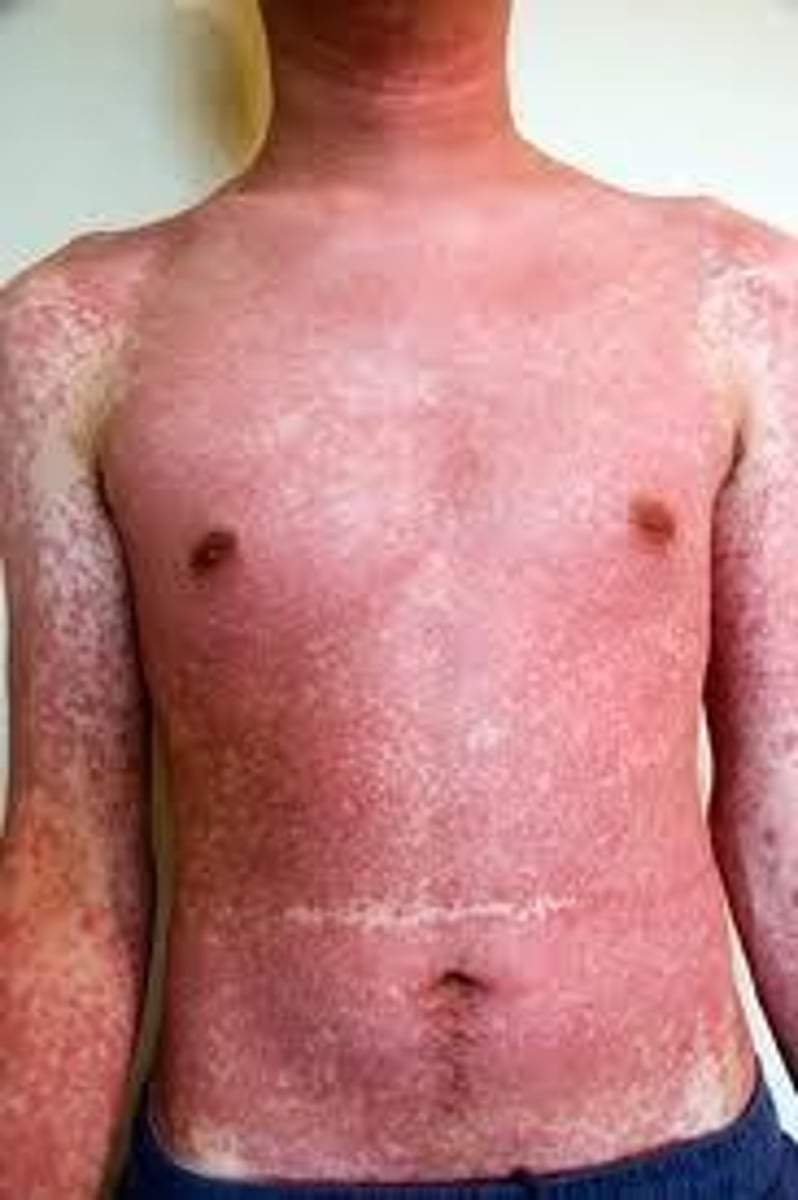 <p>maculopapular, urticaria, angioedema, SJS/TENS, erythema multiforme, fixed drug eruption</p>