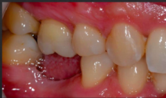 <p>Which of the following is considered a consequence of having no antagonist (lack of occlusion)?</p><p>a. Thin PDL</p><p>b. Reduction in bone density</p><p>c. Supra-eruption of tooth</p><p>d. Apparent attachment loss</p><p>e. Furcation exposure</p>