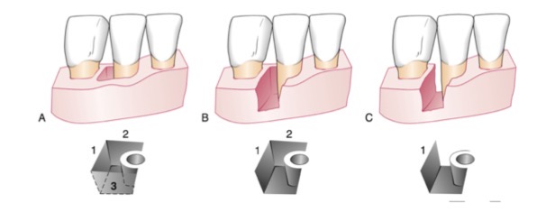 <p>The bone profile is oblique to the root profile, leaving an undercut pocket</p><p>in the bone along the root. Depending on the number of bone walls we talk about</p><p>- Defect of 3 walls- worst prognosis </p><p>- Defect of 2 walls</p><p>- Defect of 1 wall- can clean and put in bone graft </p>