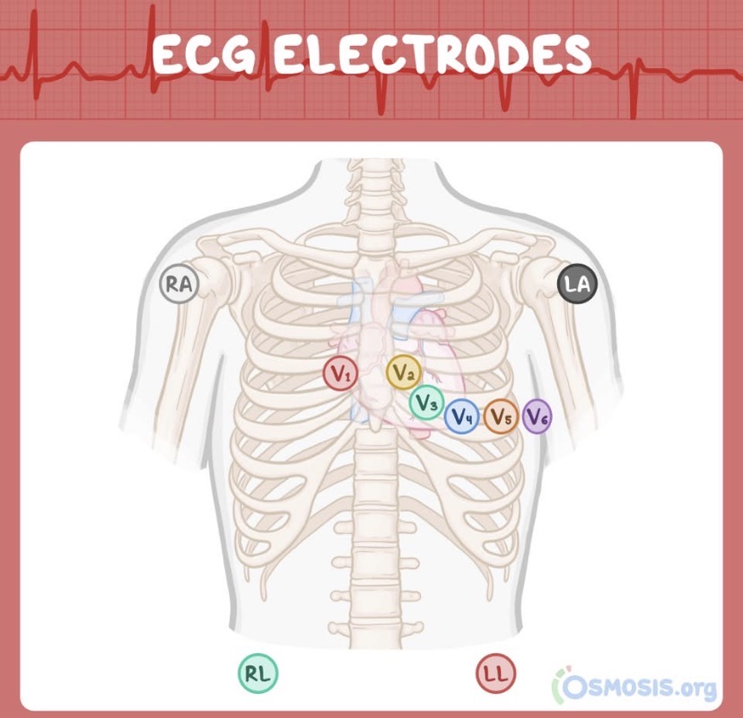 <p>(RA) Right Arm</p>