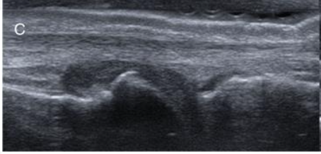 <p>Grade this synovial hypertrophy</p>