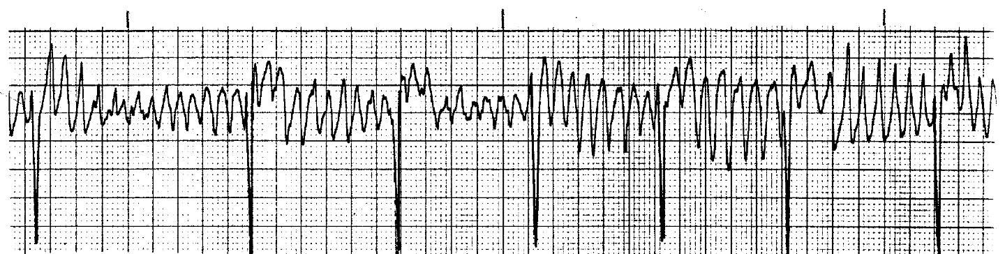 <p>What ECG is this? </p>