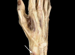 <p>In this posterior view of the right hand, identify the nerve indicated by the arrow.</p>