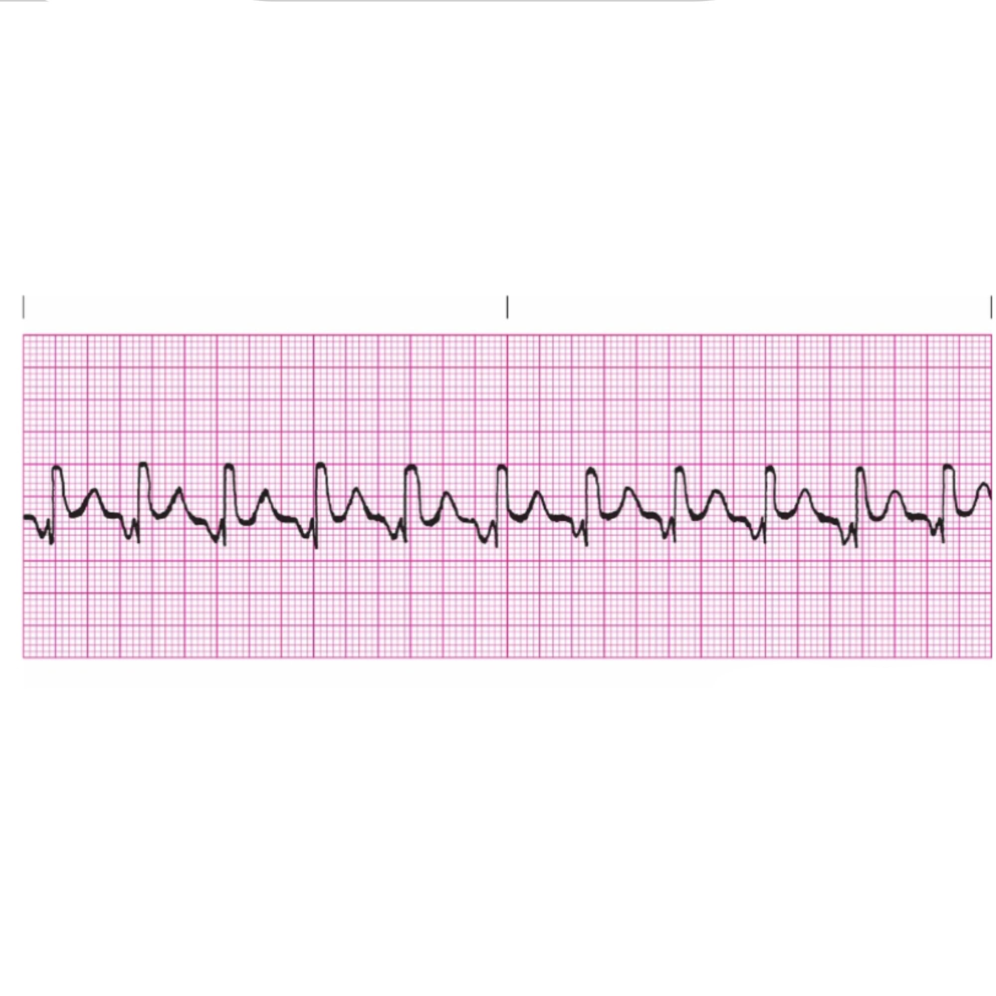<p>Rules for Junctional Tachycardia includes</p>