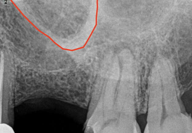 <p>What can overlap with root apices?</p>