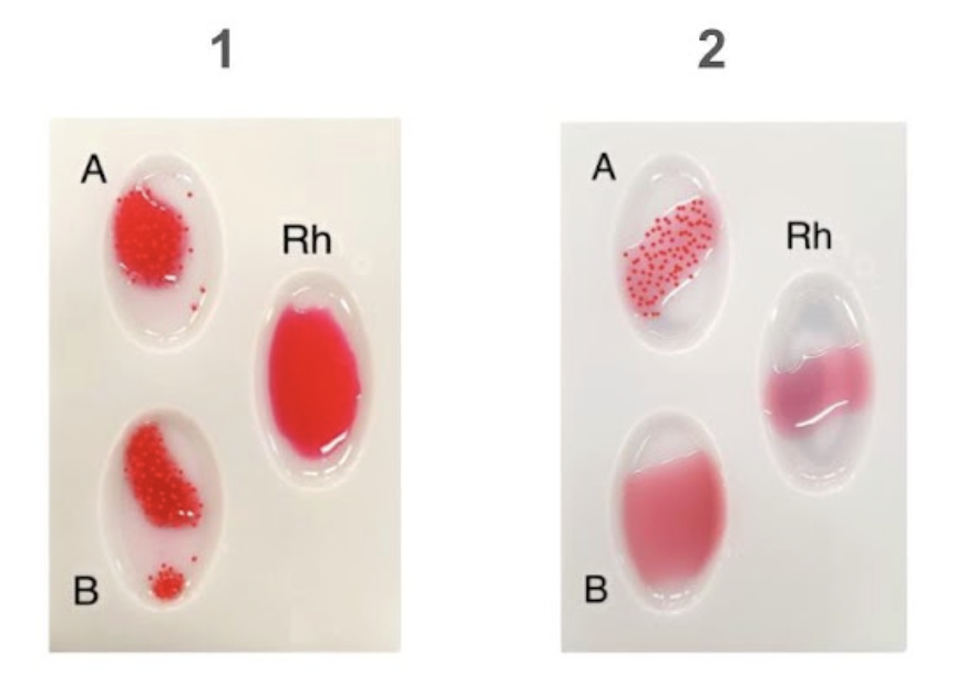 <p><span style="line-height: 1.5;">60. Observe the results from a blood typing experiment below. Which of the following statements is correct regarding the samples?<br></span></p><p><span style="line-height: 1.5;">A. 1 = AB negative, 2 = A negative</span></p><p><span style="line-height: 1.5;">B. 1 = A negative, 2 = AB positive</span></p><p><span style="line-height: 1.5;">C. 1 = O negative, 2 = A positive</span></p><p><span style="line-height: 1.5;">D. 1 = O positive, 2 = A negative</span></p>