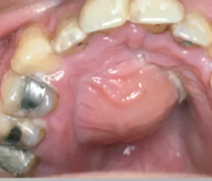 <p>pt presents with pain on percussion, biting or palpitaion</p>
