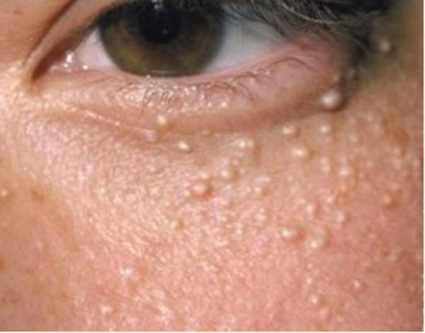 <p>Benign, keratin-filled cysts that can appear just under the epidermis and have no visible opening.</p>