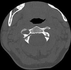 <p>- mildest form in which the ligamentous injury leads to partial uncovering of facet joint</p><p>- results in mild anterior displacement of one vertebral body on another</p>