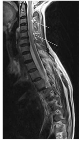 <p>Clinical Features of Vit B12 Deficiency</p>