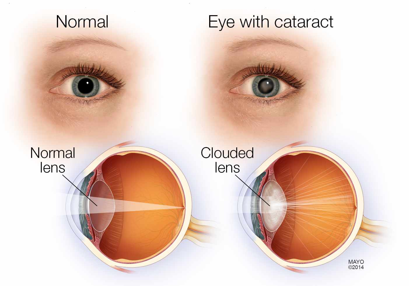 <p>PP: clouding of the lens (behind iris+pupil)→vision loss</p><p>E: m/c vision loss over 40+ y/o<br>#1 cause of blindness worldwide<br>age<br>UV light<br>DM<br>smoking<br>injury<br>steroids</p><p>CM: blurry vision (even with glasses on)<br>glare<br>decreased color brightness</p><p>TX: cataract extraction surgery</p>