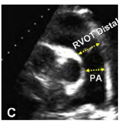<p>RVOT distal diameter measured at end diastole. Inner edge to inner edge just proximal to the pulmonic valve </p><p>Abnormal is a Diameter > 2.5 cm</p>