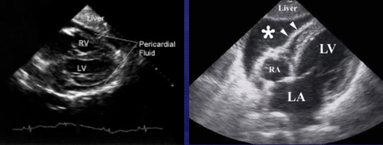 <p>Presence of fluid within the pericardium</p>