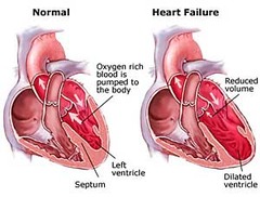 <p>heart failure</p>