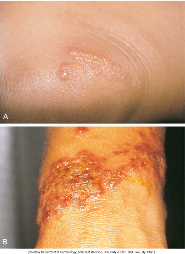 <p>a type IV delayed hypersensitivity rxn that occurs when skin is exposed to allergen which the person has been sensitized; response triggered by T cells and can lead to redness, swelling, and blistering of the skin. </p>