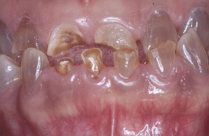 <p>affects both dentition, steel-grey/ translucent/ opalescent crowns, brittle enamel </p>