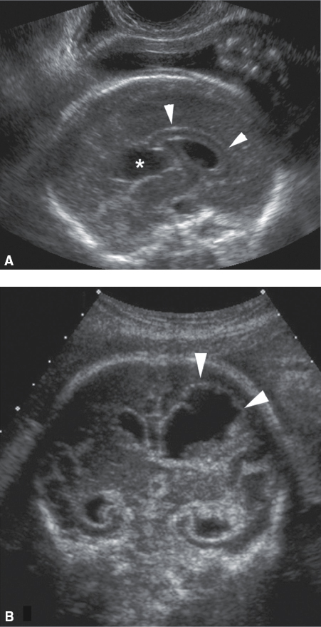 <p>arachnoid cysts will not communicate with the ventricular system.</p>